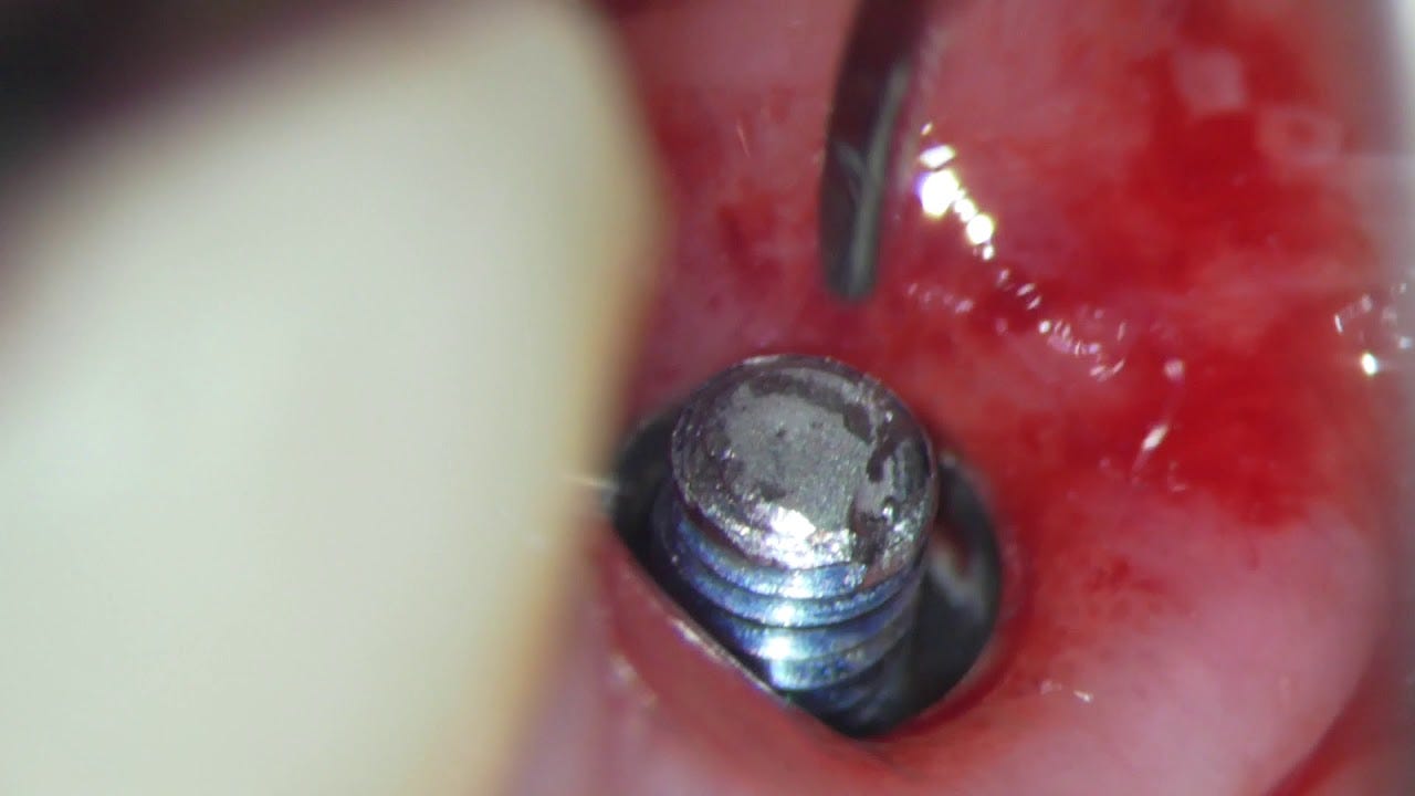 implant broken screw removal with microscope - YouTube