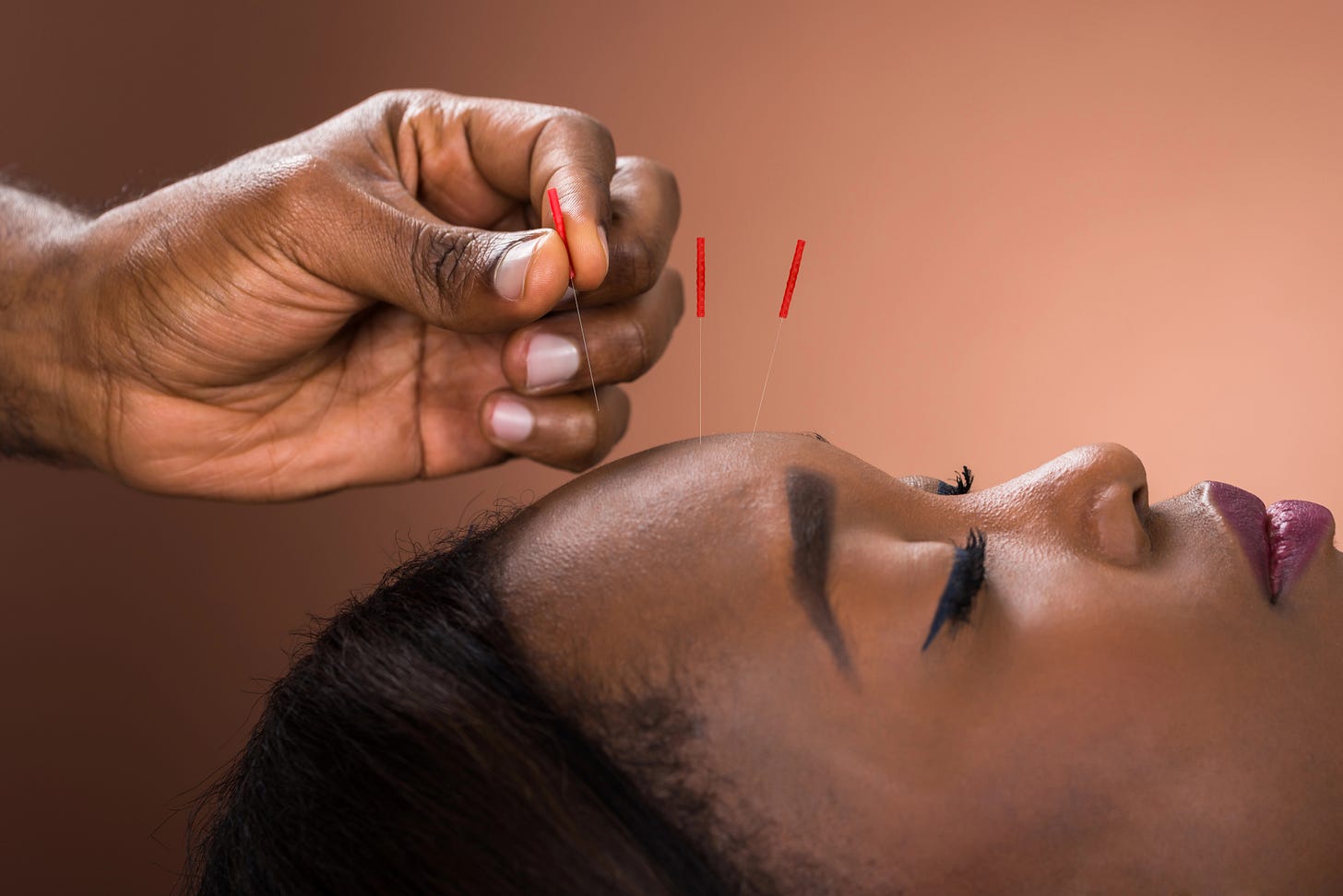 young Black woman receiving acupuncture on her face