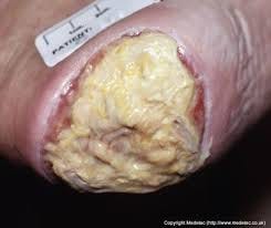 Esfacelo en herida crónica