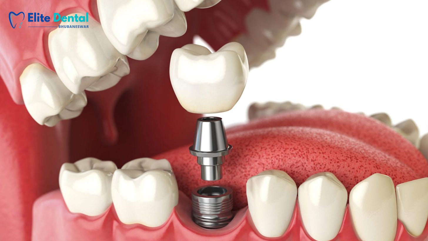 Dental fixing in Bhubaneswar