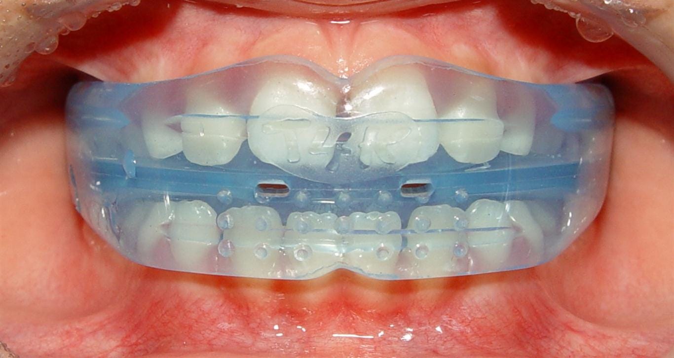 Let's talk about myofunctional orthodontics….. - Kevin O'Brien's  Orthodontic Blog