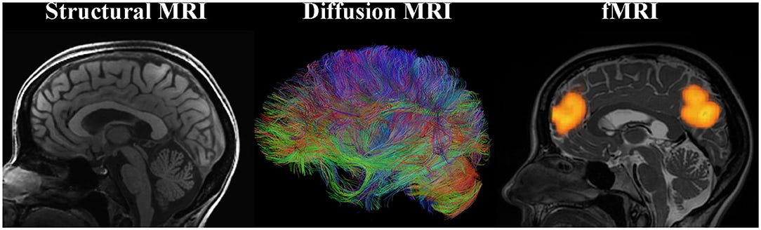 Frontiers | Training-Induced Neural Plasticity in Youth: A Systematic  Review of Structural and Functional MRI Studies