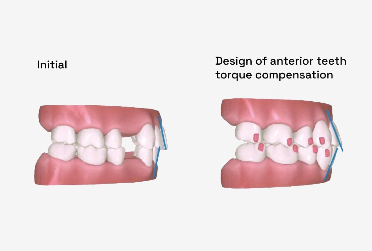 A7 Premolar Extraction - Angel Aligner