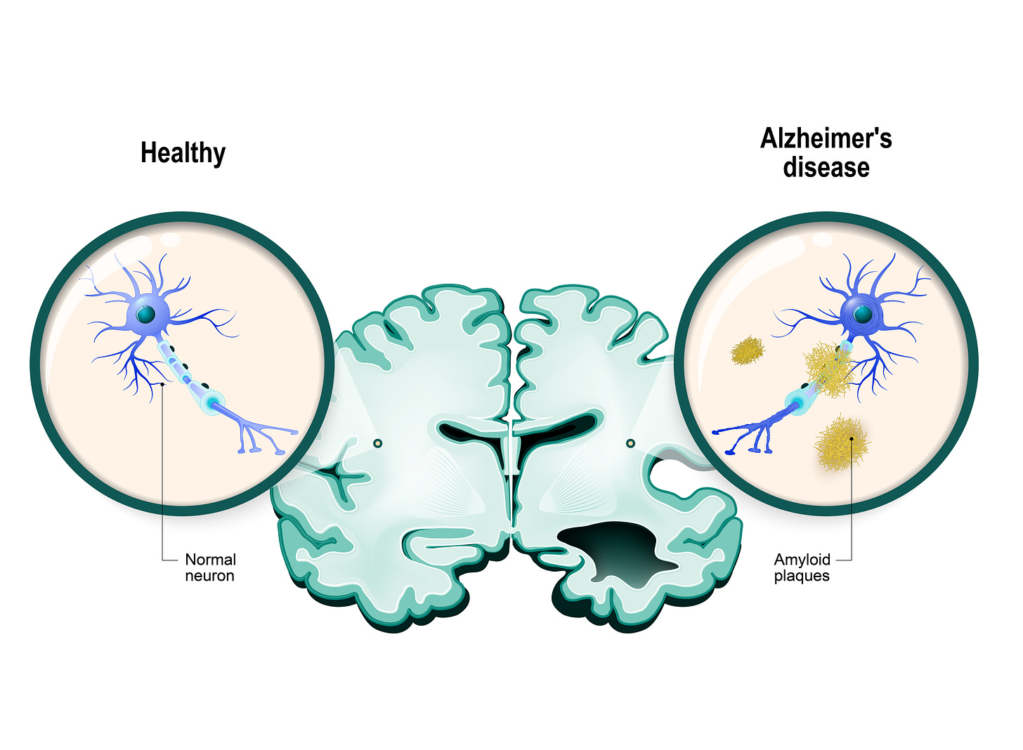 Alzheimer Plaque Affects Different Brain Cells Differently - Research &  Development World