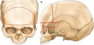 Frontal Monobloc Osteotomies ...