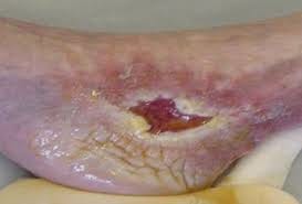 Borde perilesional macerado — blanco, arrugado, frágil