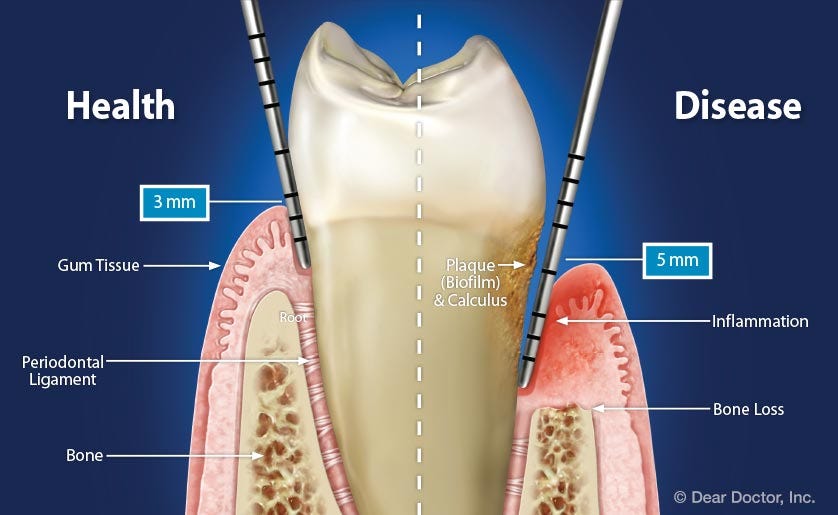 https://www.deardoctor.com/images/ddwc/features/understanding-periodontal-pockets/health-vs-disease-periodontal-pocket.jpg