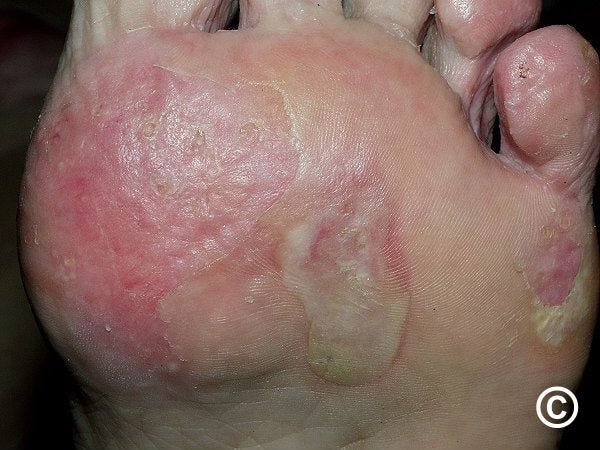 Epidermolysis bullosa acquisita