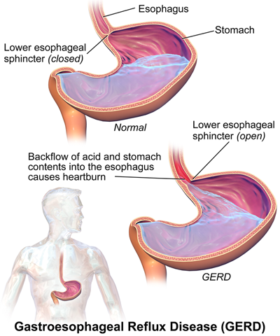 Risks of GERD can be eliminated with LINX