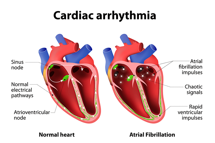 Arrhythmia | Symptoms, Causes, Treatment & Prevention