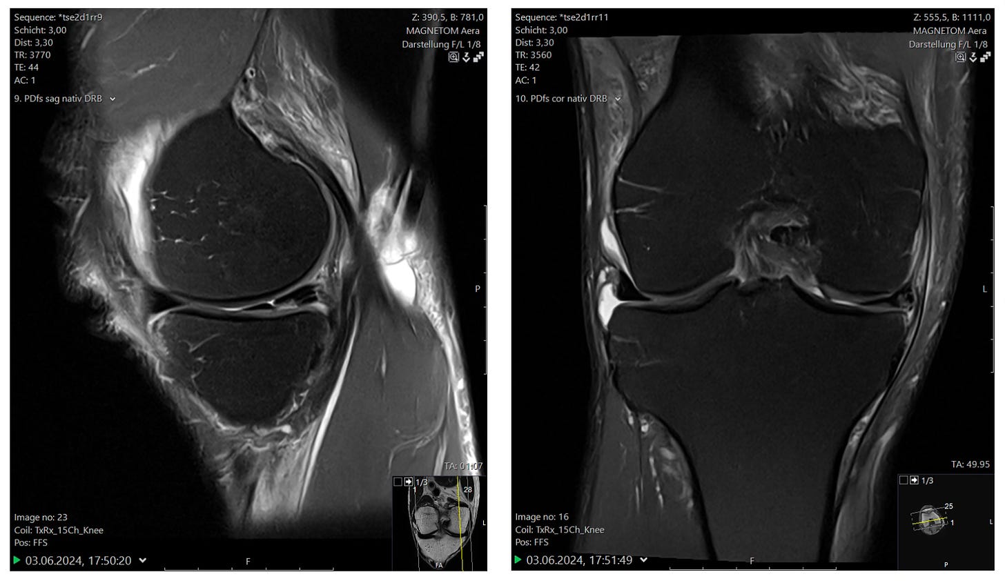 MRI screenshot of the torn meniscus