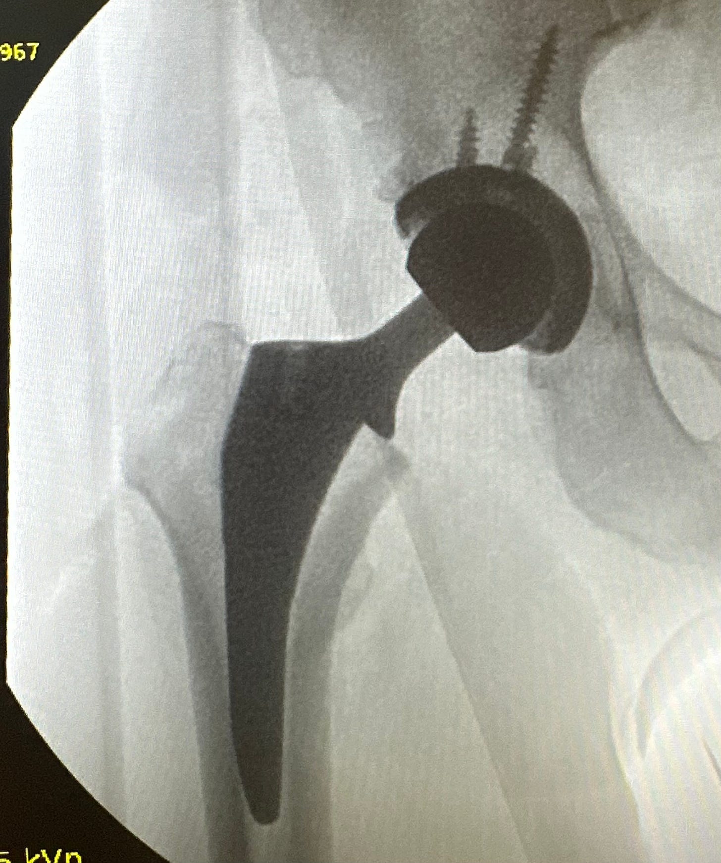 An x-ray of Jeff’s new hip.