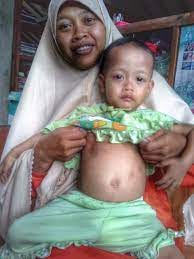 File:Child Infected with Measles - Indonesia (17057698945).jpg - Wikimedia  Commons