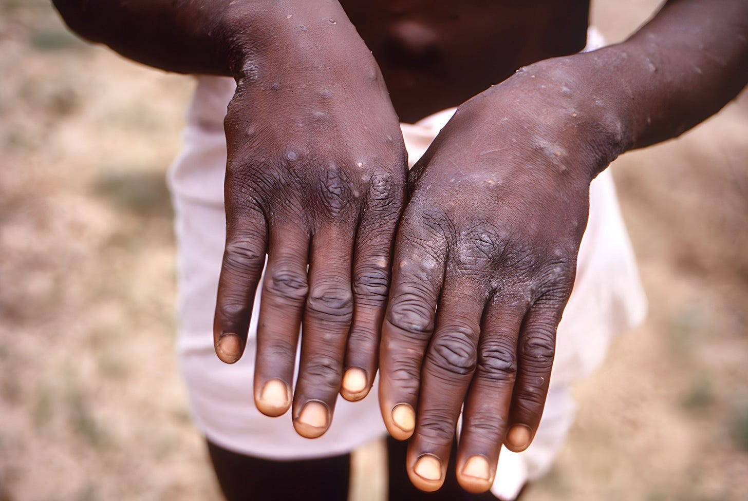 Human monkeypox or monkeypox