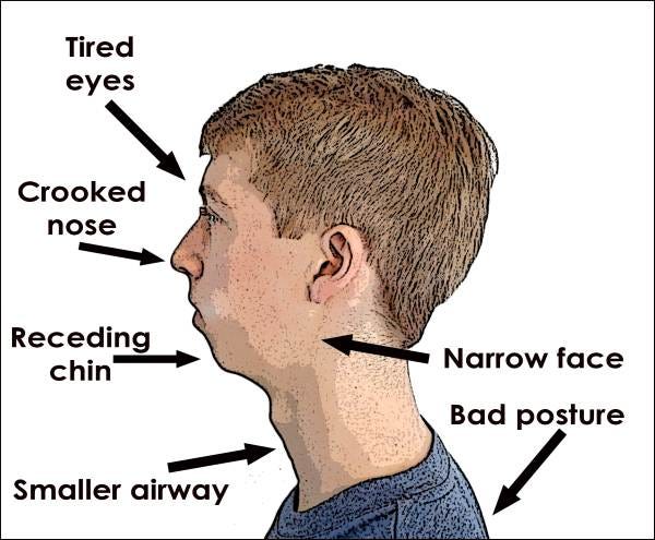 Mouth Breathing. - educatingalpacas.com