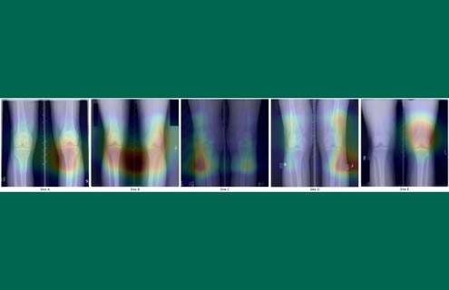 Knee X-rays with salient mapping