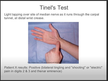 tinels test for cts