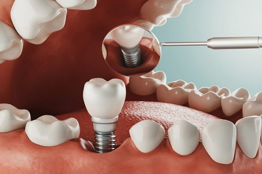 dental-implant Bhubaneswar
