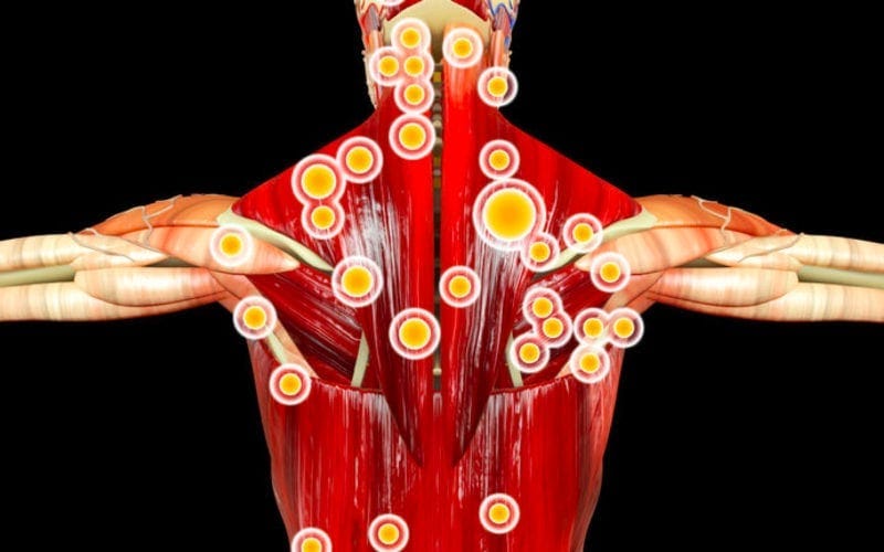 What are Trigger Points? - StretchSPOT