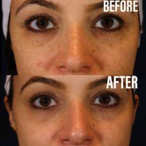 Union Square Dermatology Before And After