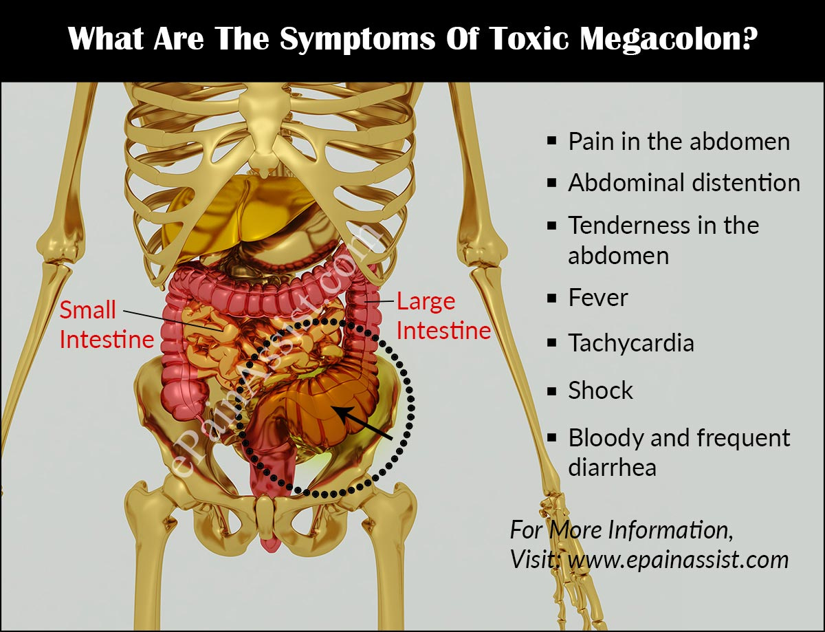https://www.epainassist.com/images/what-are-the-symptoms-of-toxic-megacolon-preview.jpg