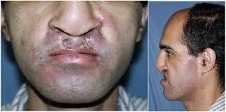 Cleft — Lip Nasal Deformities ...