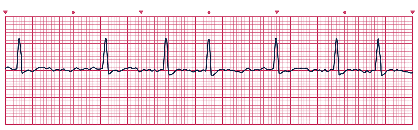 An ECG depicting Atrial Fibrillation