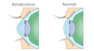 Image result for keratoconus Image result for keratoconus