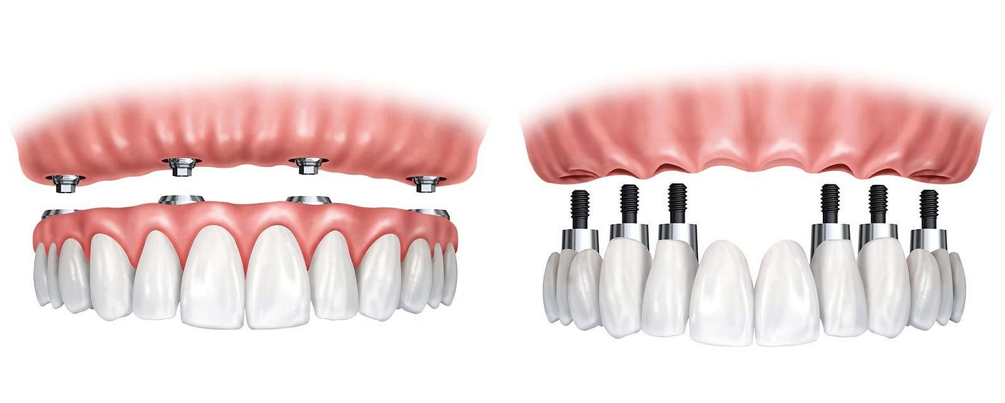 All-on-4 Dental Implants Charlotte, NC - Ballantyne, NC - Gastonia, NC - Advanced Dentistry of Blakeney All-on-4 Dental Implants Charlotte, NC - Ballantyne, NC - Gastonia, NC - Advanced Dentistry of Blakeney
