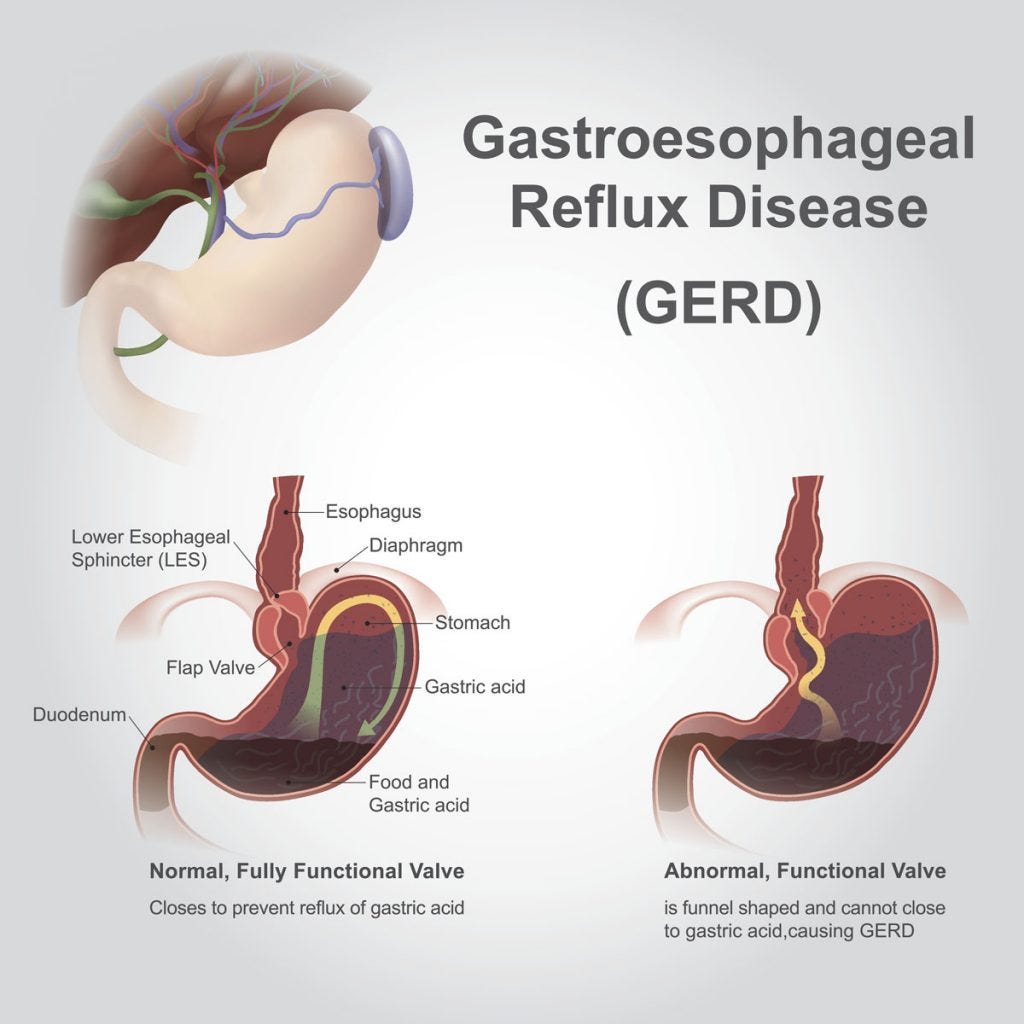 Living Well: Frequent acid reflux could point to more serious condition |  CraigDailyPress.com