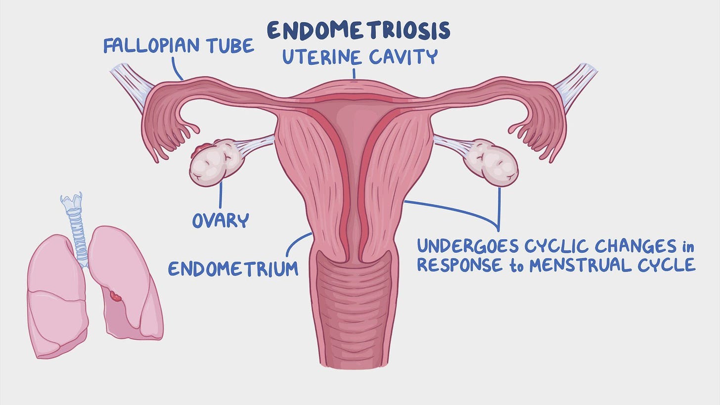 Endometriosis: Nursing - Osmosis Video Library