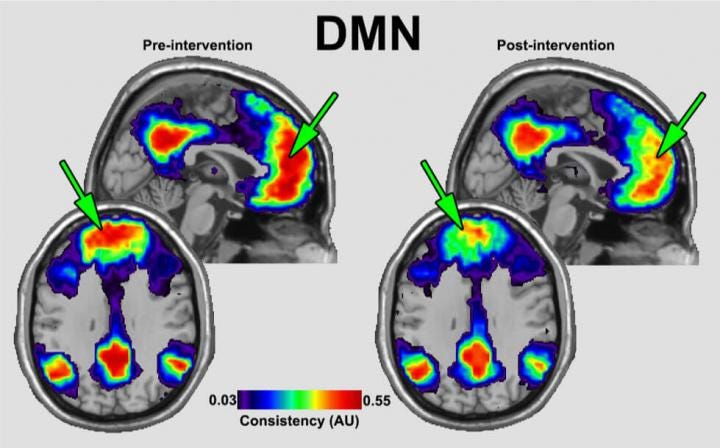 fMRI image of Default Mode Net [IMAGE] | EurekAlert! Science News Releases