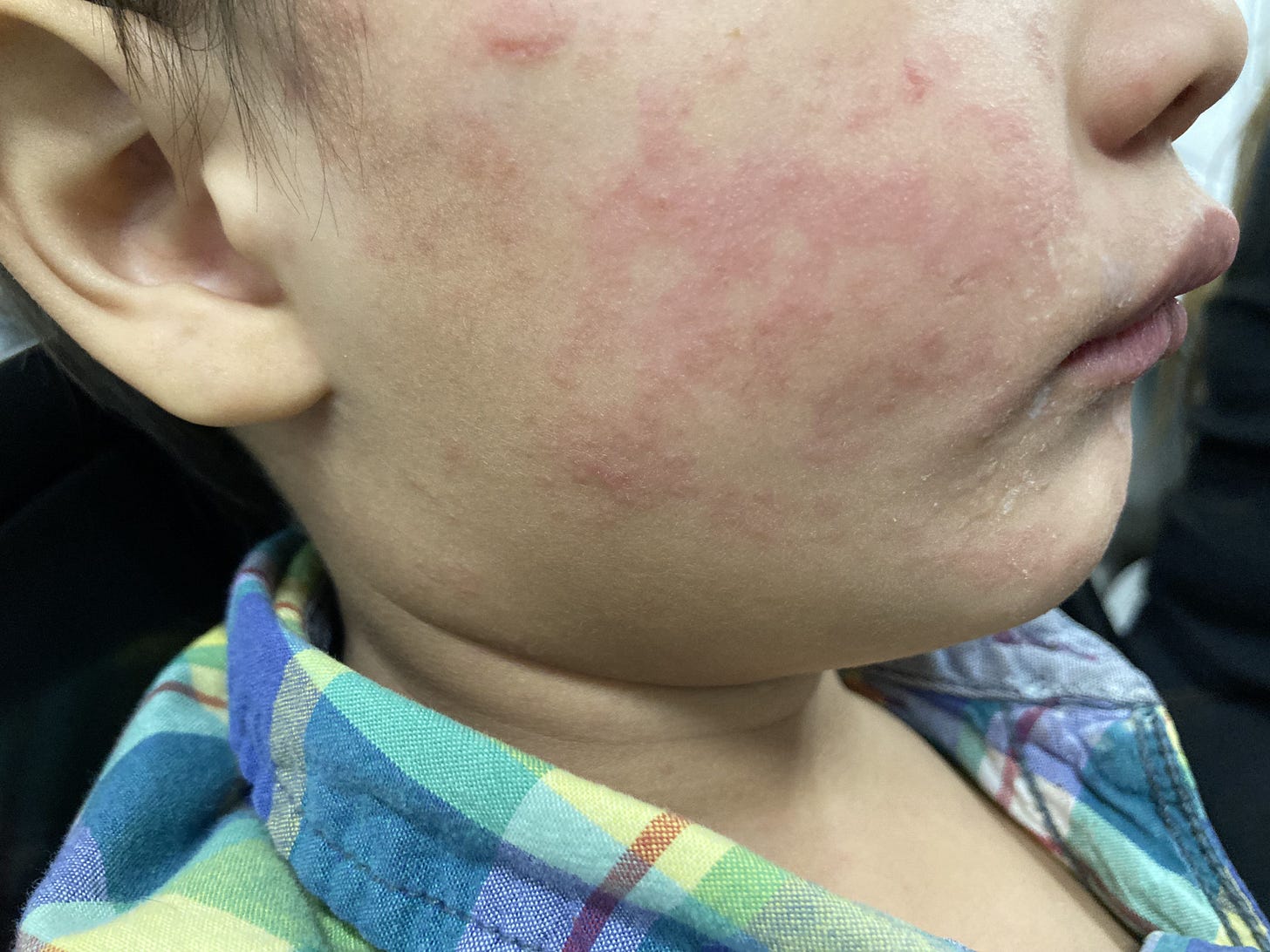 Measles outbreak spreads as cases rise in Texas, New Mexico