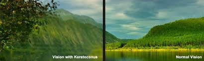 Image result for keratoconus Image result for keratoconus