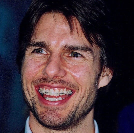 Tom Cruise's Teeth | The London Lingual Orthodontic Clinic