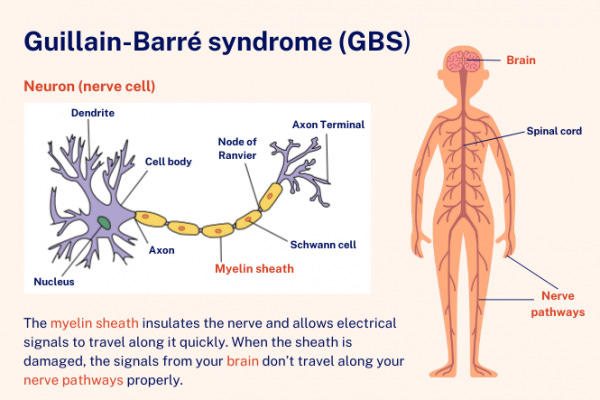 Guillain-Barre syndrome | Healthify