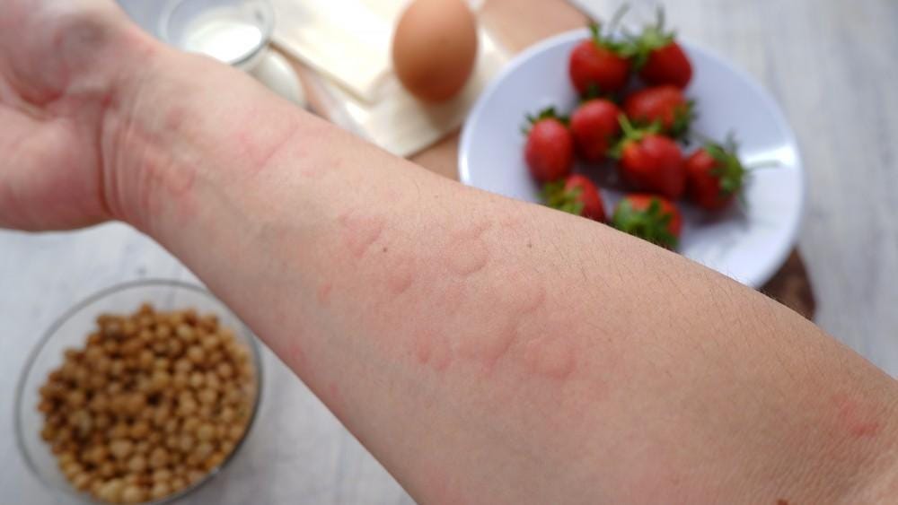 Why Are Peanut Allergies on the Rise?: Advanced Allergy and Asthma:  Allergists