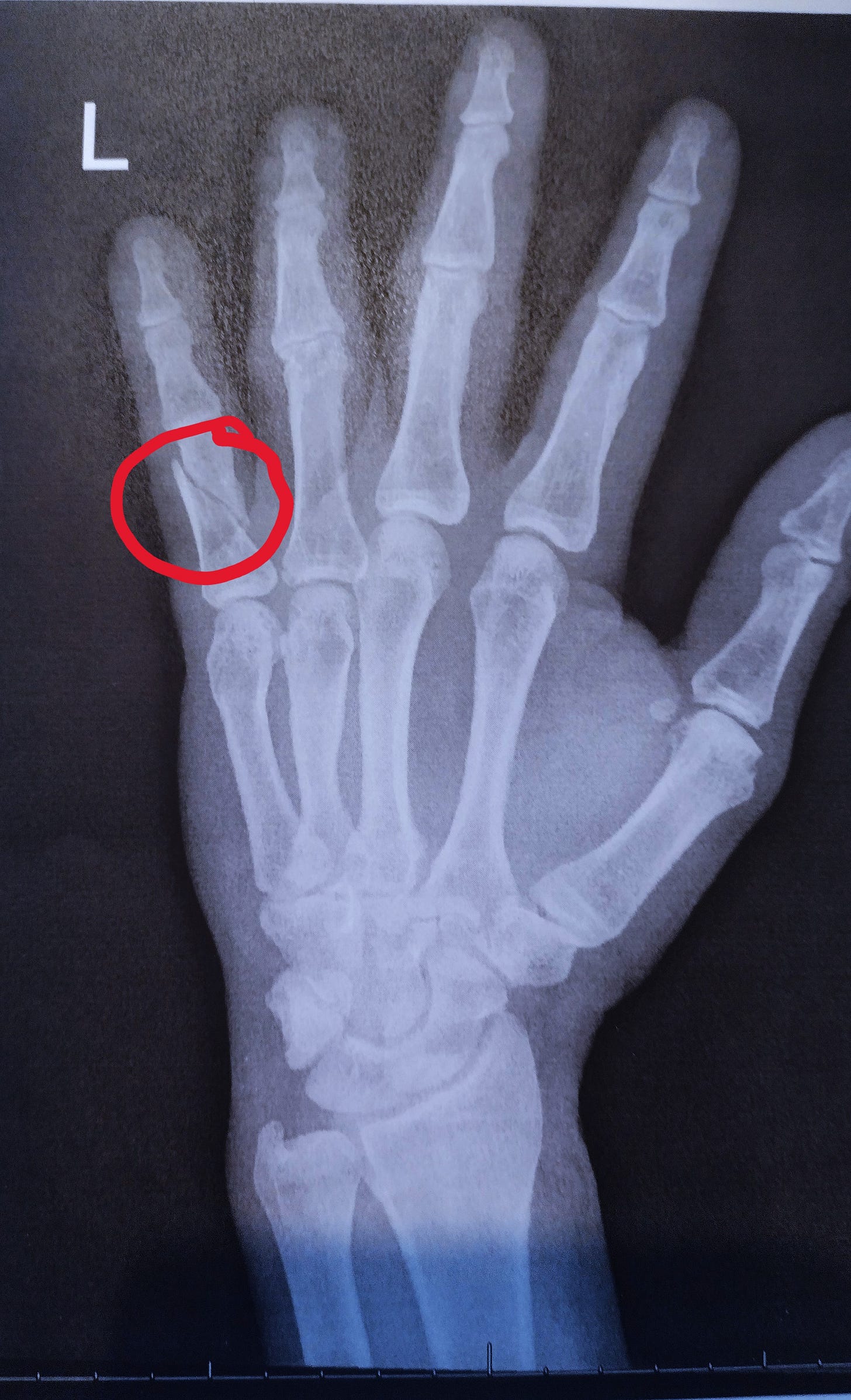 Xray image of my husband's hand