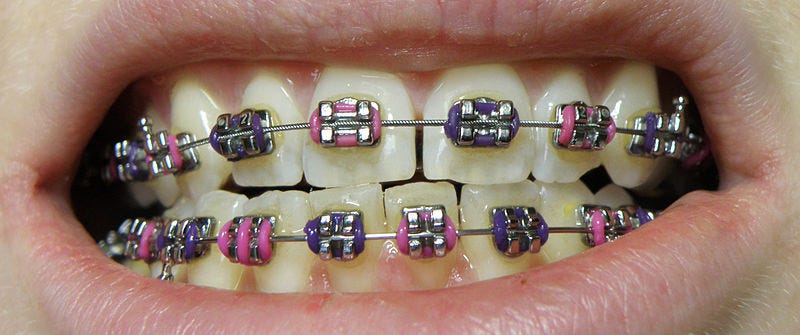 Dental braces - Wikipedia