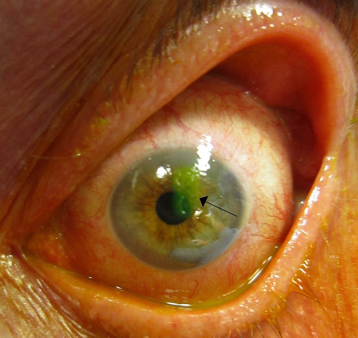Corneal abrasion - Wikipedia