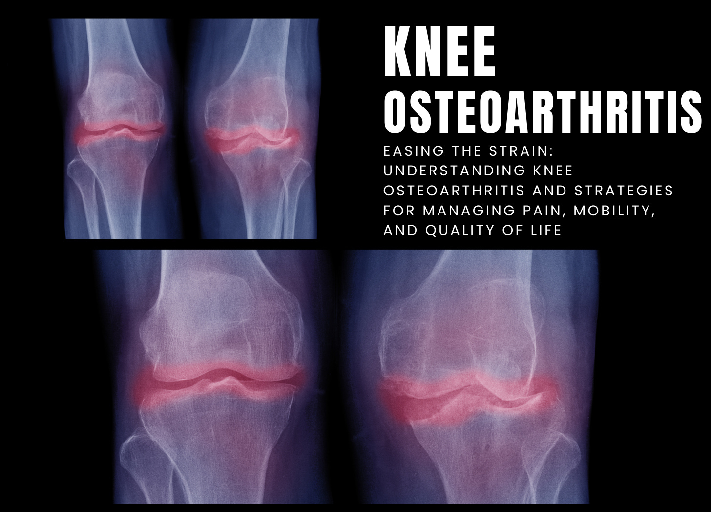 Knee Osteoarthritis: Causes, Symptoms, And Treatment