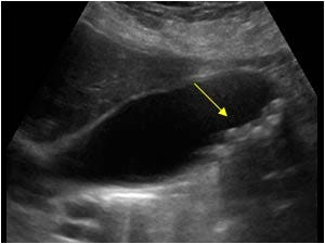 1.2.1 Gallbladder: Gallstones | Ultrasound Cases