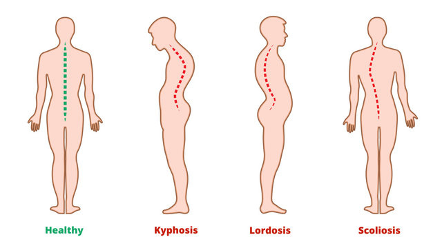 Lordosis Images – Browse 2,297 Stock Photos, Vectors, and ...