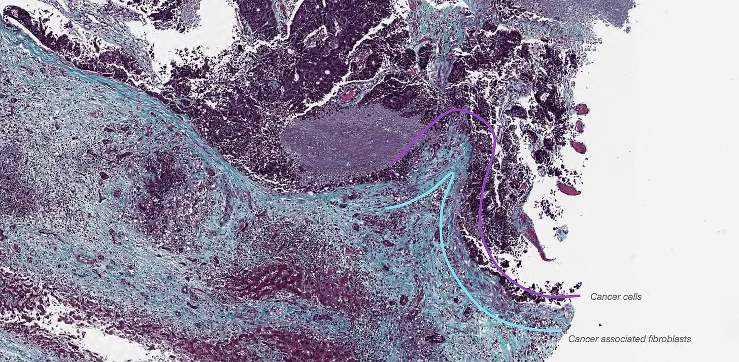 Phenomic AI tumor with cancer screenshot