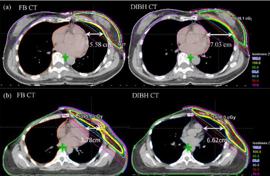 Free breathing CT vs DIBH CT - note increases in the measurements given the physician greater flexibility to avoid the heart.