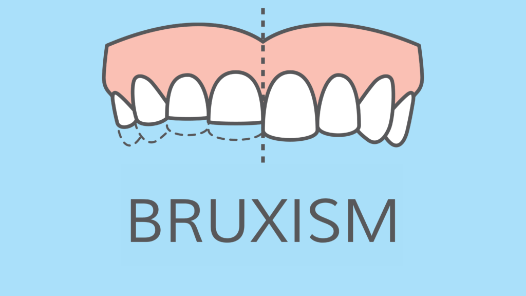 What is Bruxism? – Enlighten Smiles