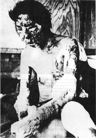 TIL that after the bombing of Hiroshima, there were “ant-walking  alligators” that the survivors saw everywhere, men and women who “were now  eyeless and faceless — with their heads transformed into blackened