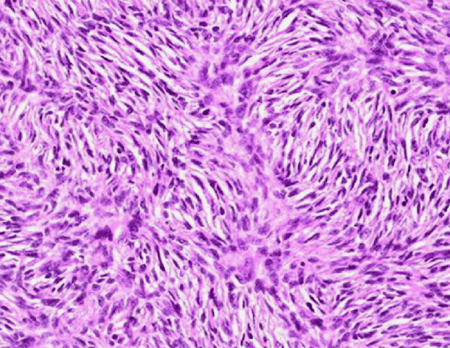 What exactly does “storiform” mean? | Pathology Student