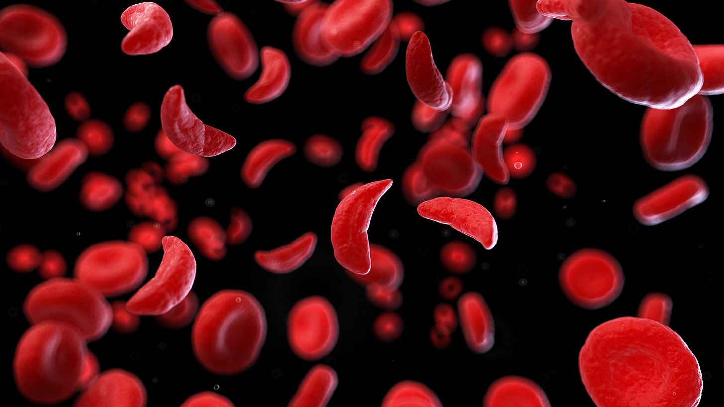 a rendering of the blood of someone with sickle cell disease