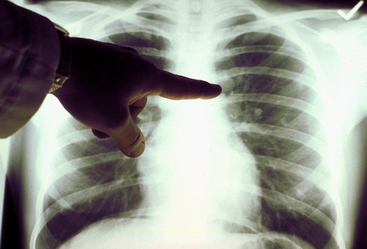 One Glaring Problem in the U.S. Plan to Reduce Cancer Deaths | Opinion -  Newsweek